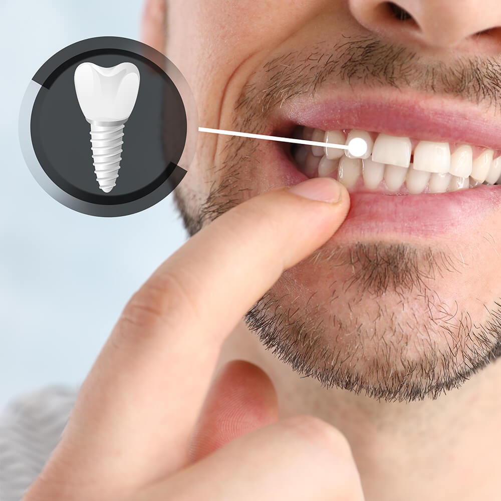 Man showing implanted teeth on light background, closeup